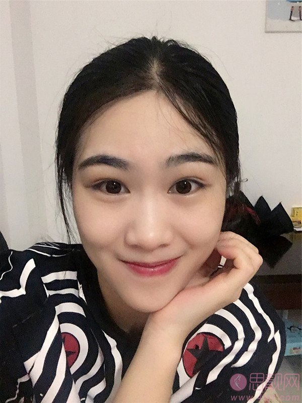 上海新形象的宣瑞军主任祛眼袋技术如何呀？附祛眼袋真人案例反馈及2020价格表曝光