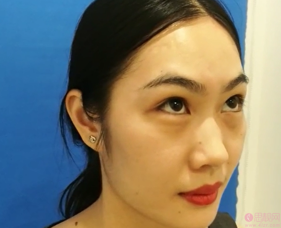 上海新形象的宣瑞军主任祛眼袋技术如何呀？附祛眼袋真人案例反馈及2020价格表曝光