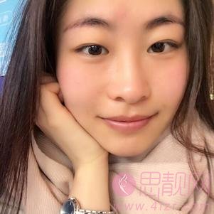 成都美莱黄小林做双眼皮怎么样？附双眼皮真人分享及2020价格表发布