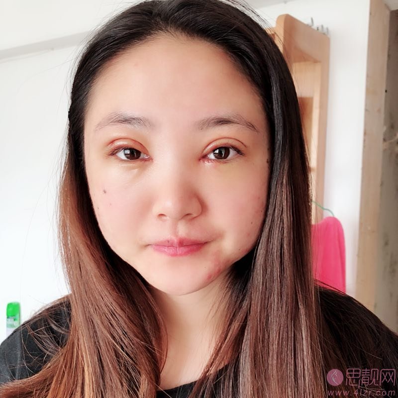 薛艳峰做双眼皮怎么样?2020价格表明细一览+双眼皮案例分享
