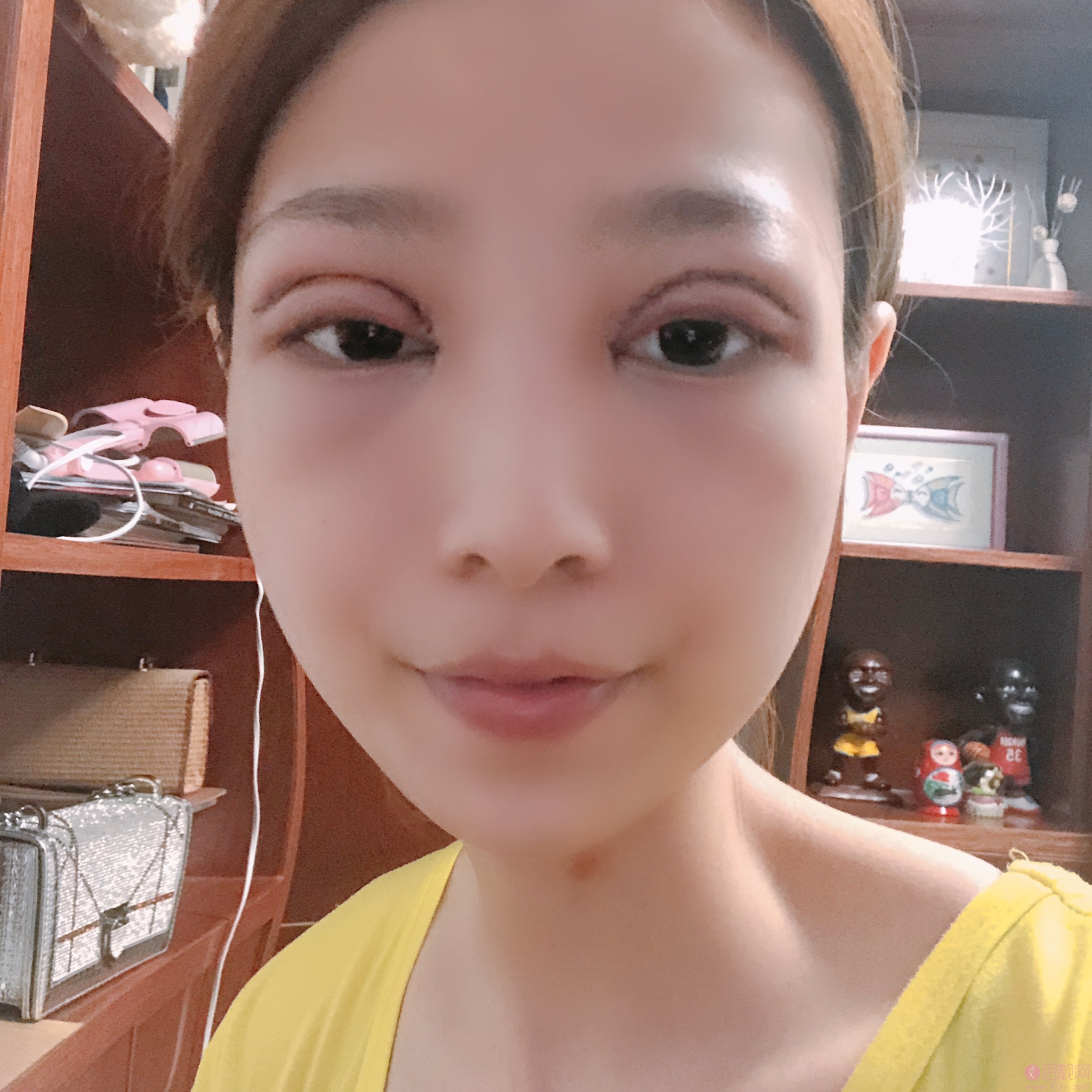 上海薇琳张怀军做的双眼皮好不好?附双眼皮真人案例反馈+2020价格表曝光