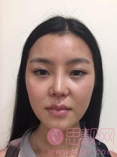 民航上海医院俞良钢医生磨骨怎么样?附磨骨真人案例反馈及2020价格表一览