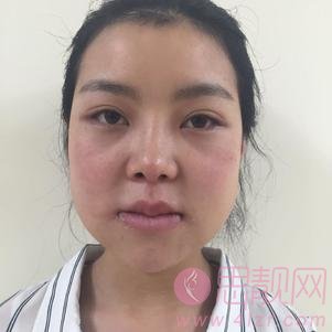 民航上海医院俞良钢医生磨骨怎么样?附磨骨真人案例反馈及2020价格表一览