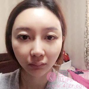 上海长征医院刘安堂隆鼻如如何？2020价格表明细一览+隆鼻真人案例分享