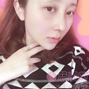 上海长征医院刘安堂隆鼻如如何？2020价格表明细一览+隆鼻真人案例分享