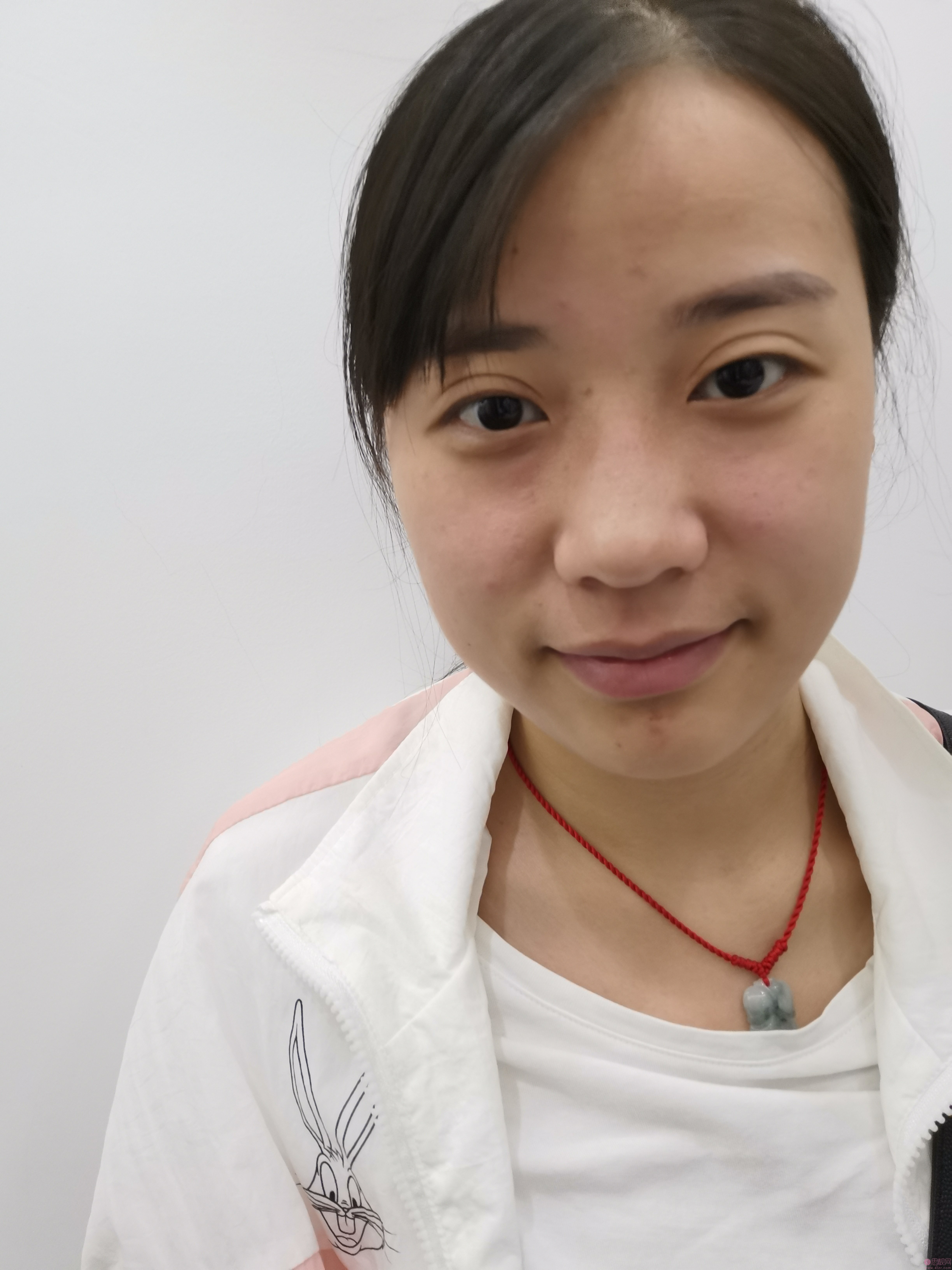 北京韩啸白永辉做双眼皮修复怎么样?附眼修复真实案例展示+2020年价格表一览
