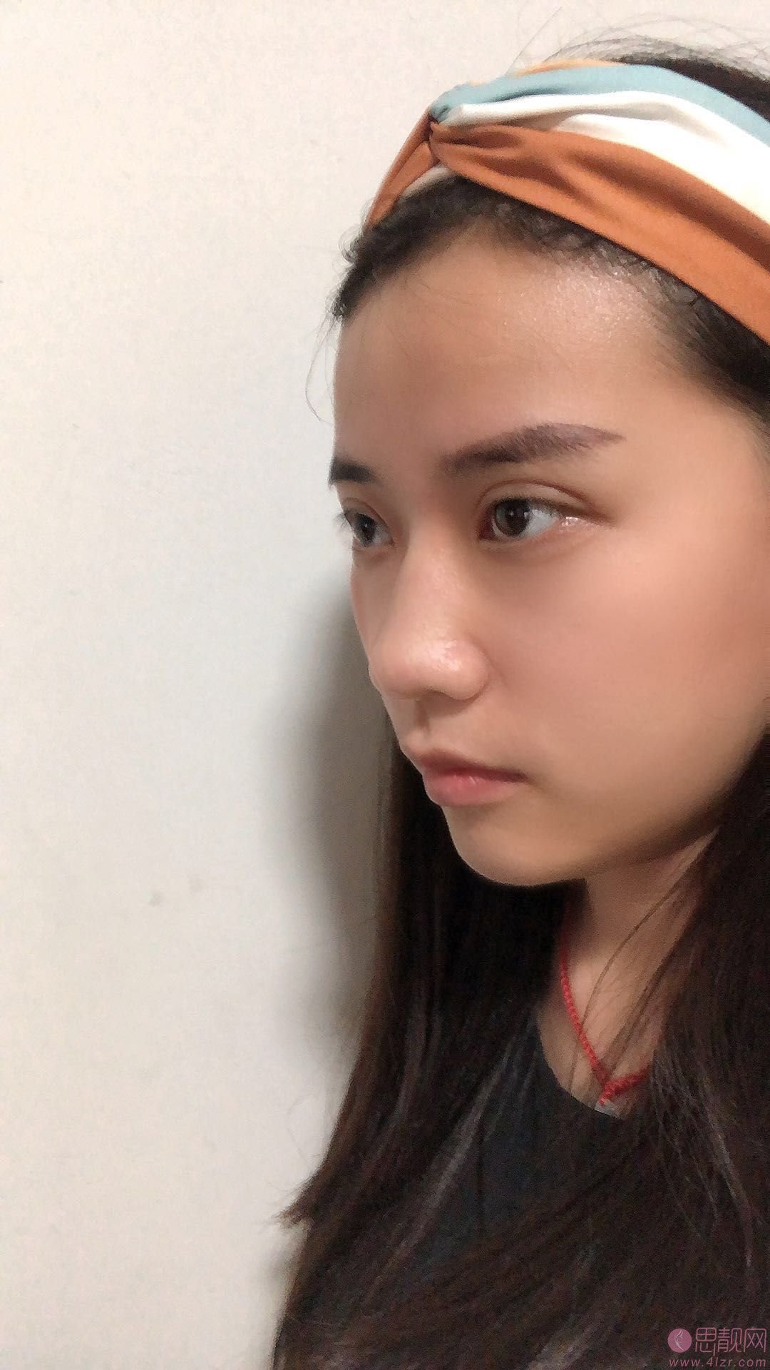 北京韩啸白永辉做双眼皮修复怎么样?附眼修复真实案例展示+2020年价格表一览