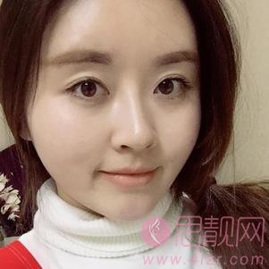 北京瑞丽舍整形医院隆鼻好不好？附隆鼻真实案例反馈及2020价格表发布