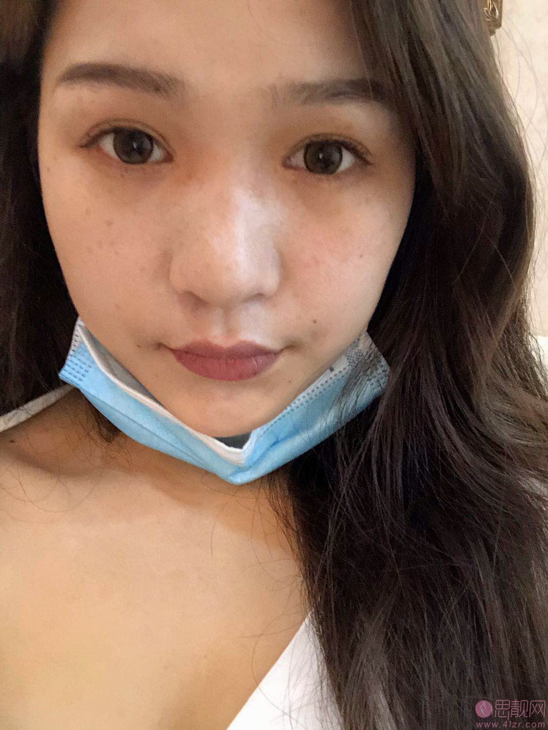 西安美立方美容医院怎么样?从口碑隆鼻案例看医院