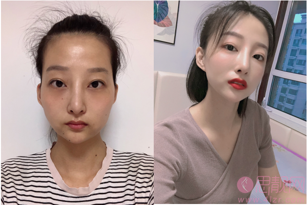 北京大学深圳医院整形