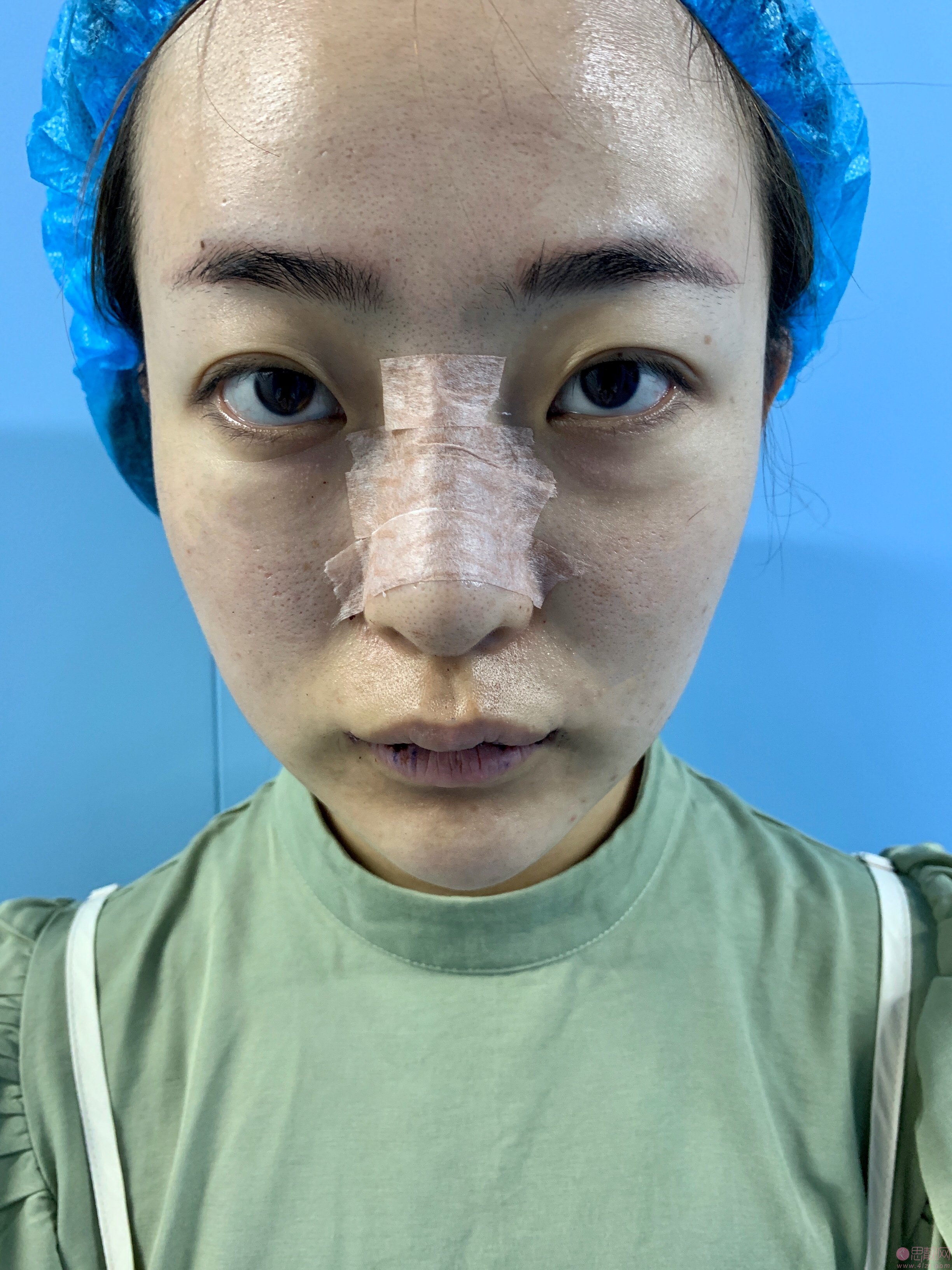 西安美立方美容医院怎么样?附隆鼻案例及2020年价格表发布
