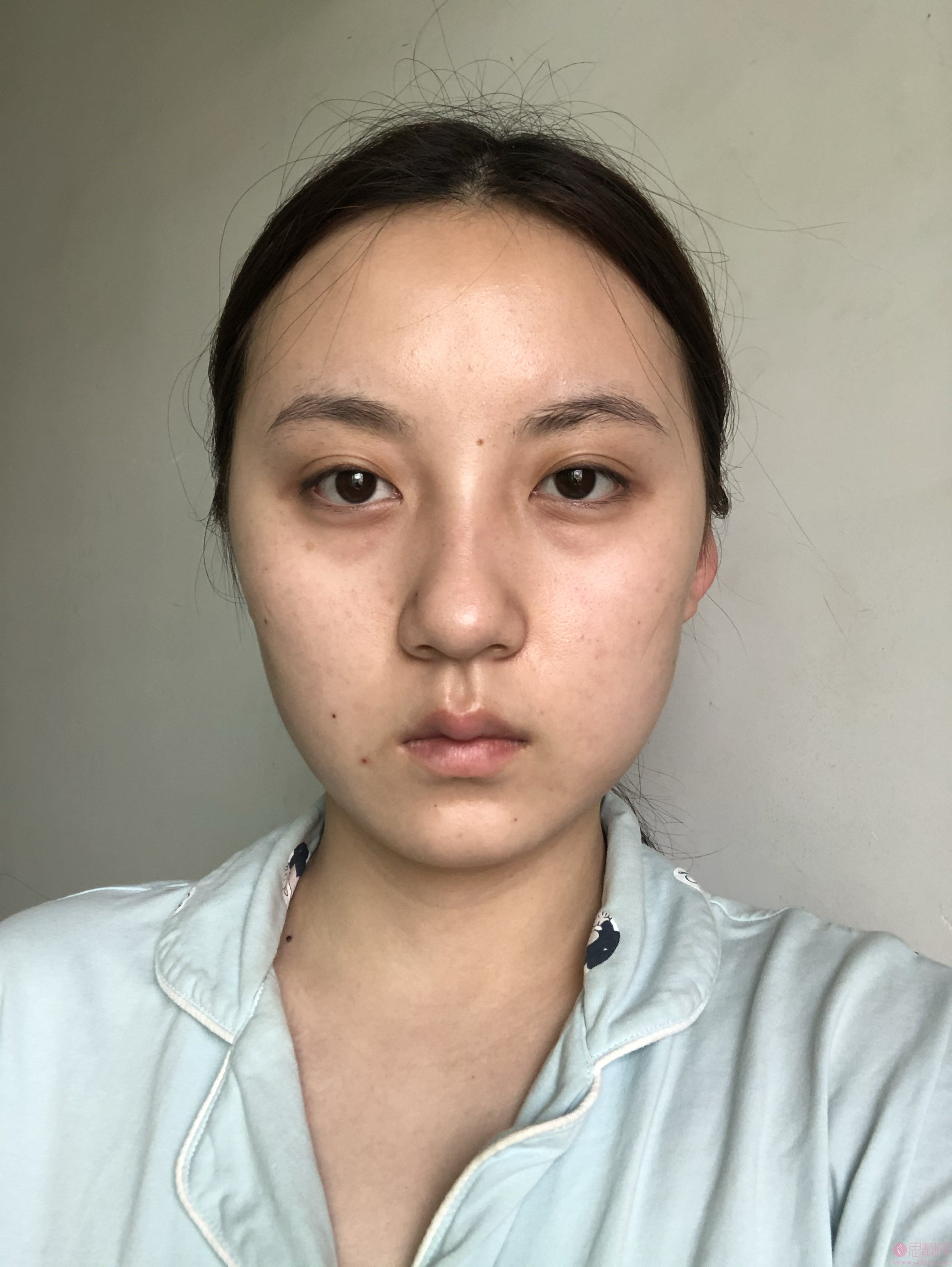 上海映九医疗美容隆鼻怎么样?附隆鼻真实案例展示及2020年价格表发布