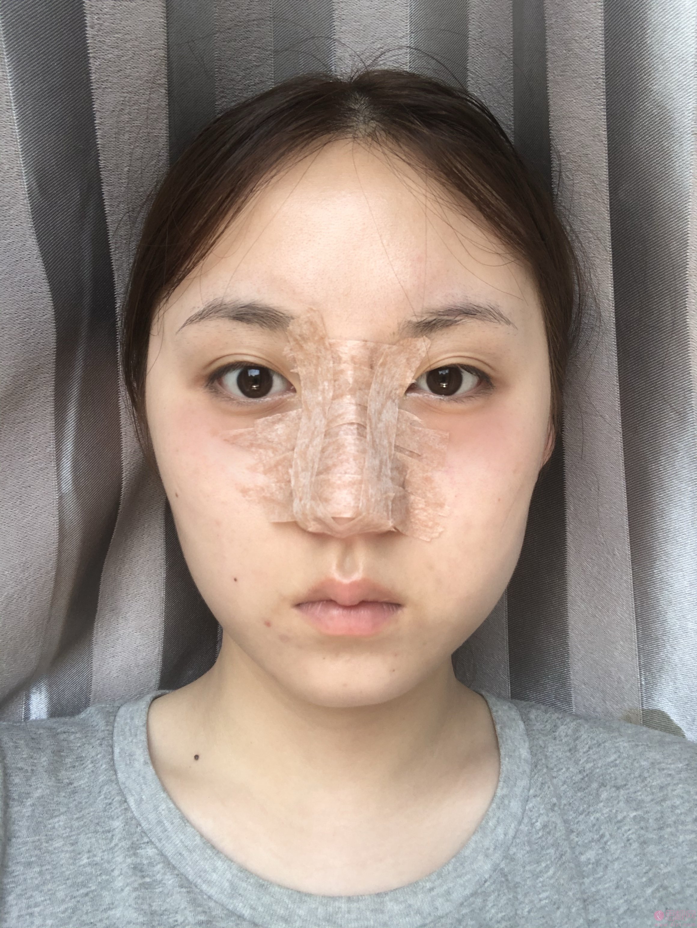 上海映九医疗美容隆鼻怎么样?附隆鼻真实案例展示及2020年价格表发布