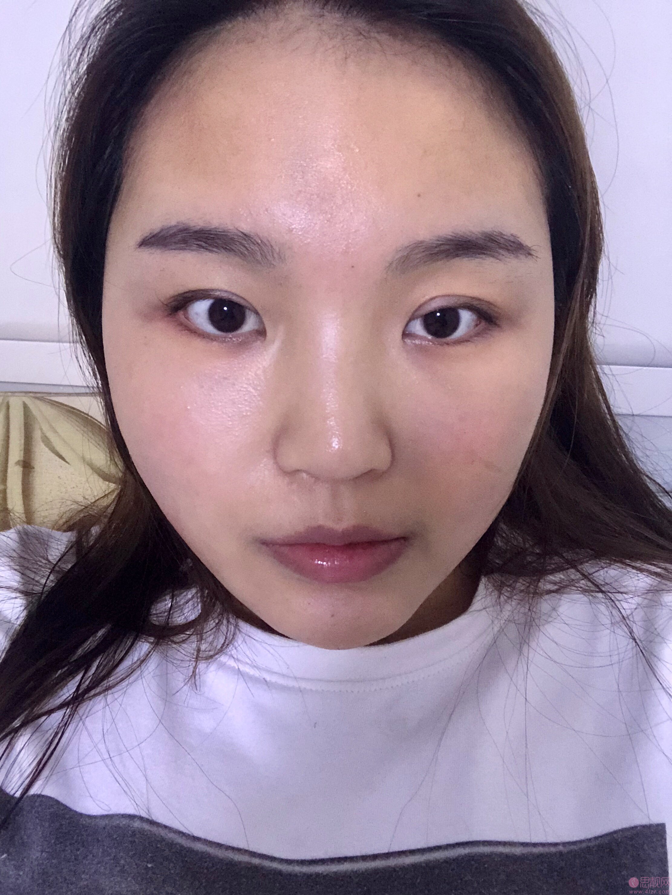 成都蜀尚荣雅美容整形医院隆鼻怎么样?附隆鼻真人案例反馈+2020价格表发布