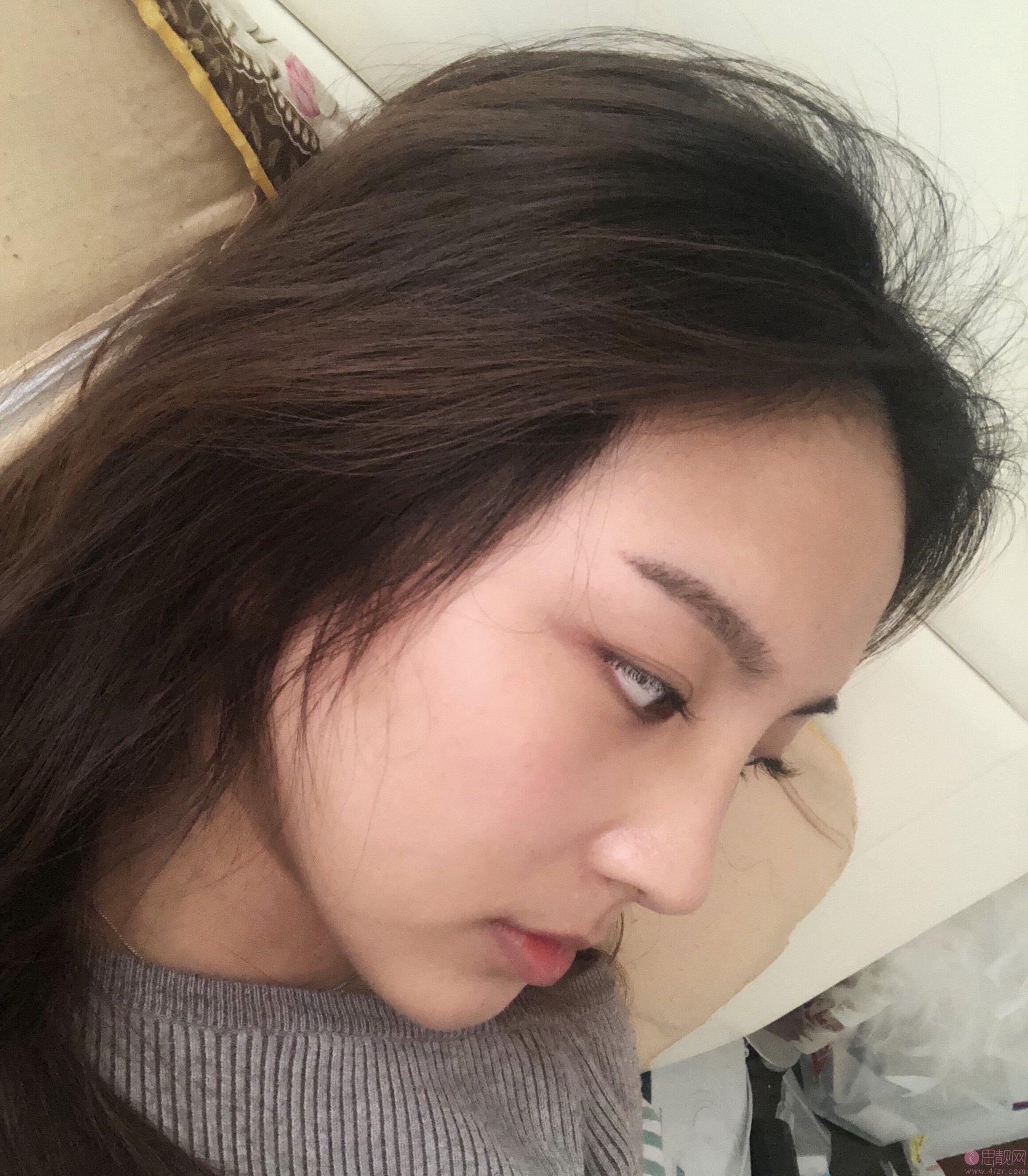 成都蜀尚荣雅美容整形医院隆鼻怎么样?附隆鼻真人案例反馈+2020价格表发布