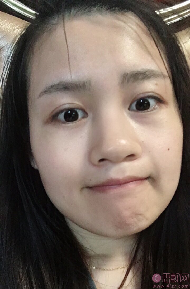 深圳赫思整形鼻王是谁?附名单及隆鼻真人案例一览