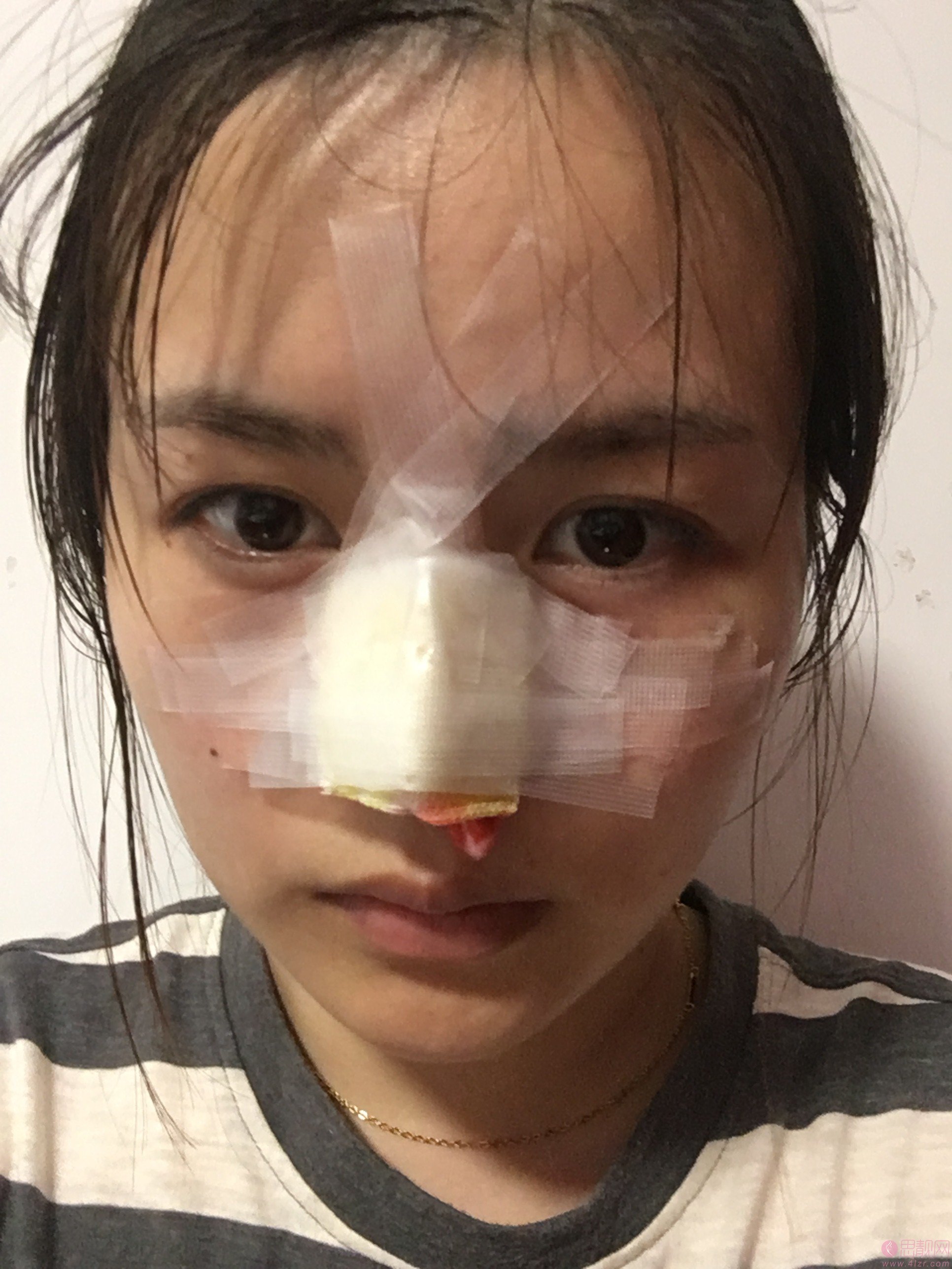 深圳赫思整形鼻王是谁?附名单及隆鼻真人案例一览