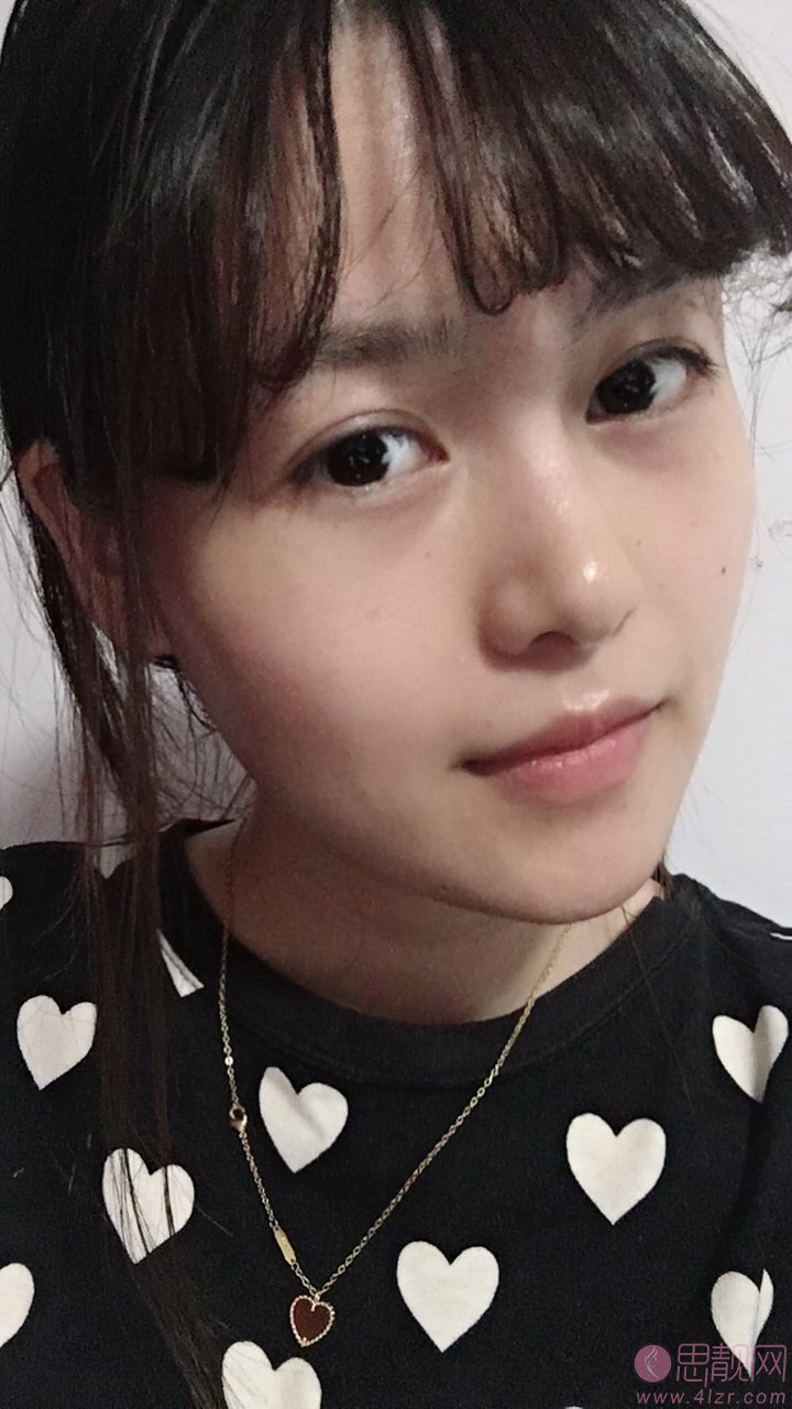 深圳赫思整形鼻王是谁?附名单及隆鼻真人案例一览