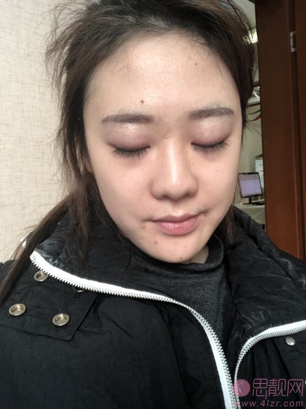 成都市三医院隆鼻怎么样?附隆鼻真人案例反馈及2020年价格表明细一览
