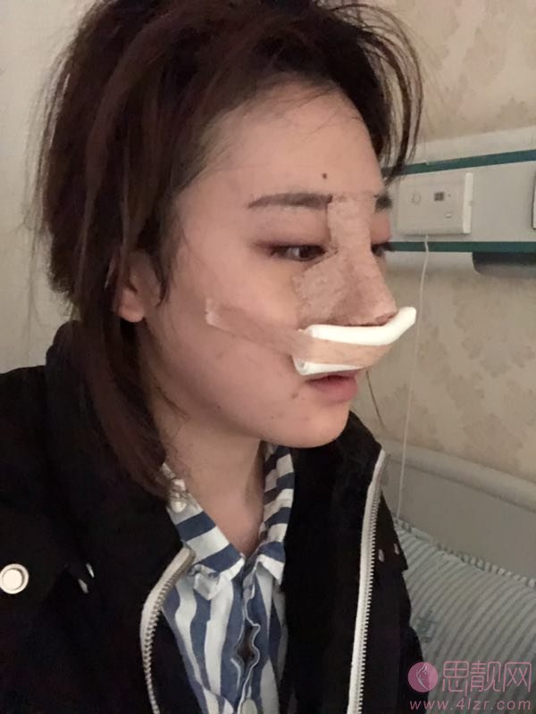 成都市三医院隆鼻怎么样?附隆鼻真人案例反馈及2020年价格表明细一览