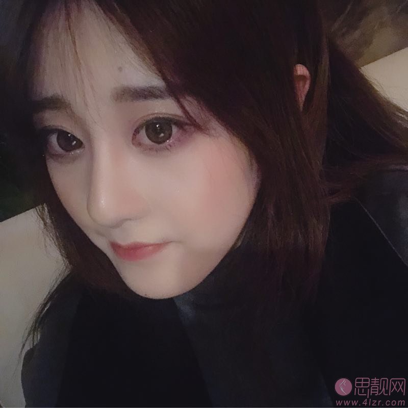成都市三医院隆鼻怎么样？附隆鼻真人案例反馈及2020年价格表明细一览