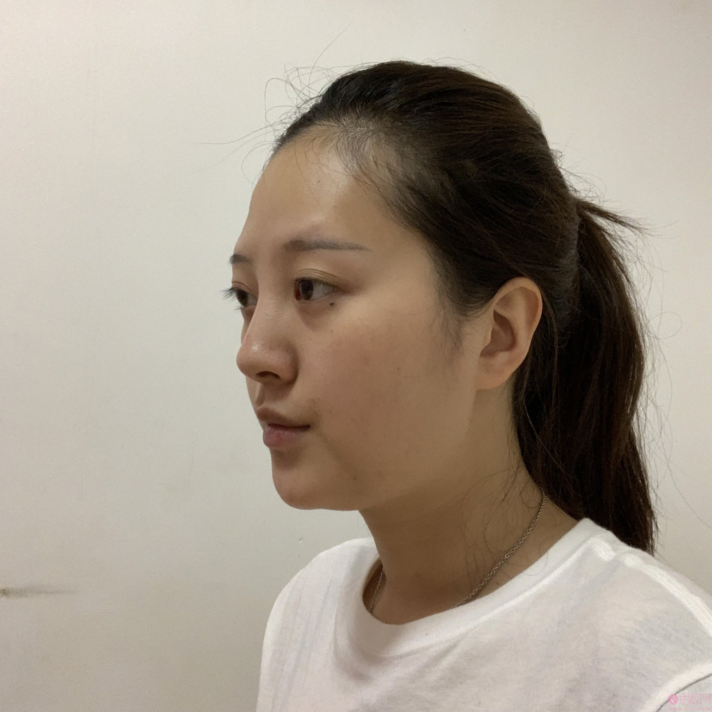 合肥亚典美容医院陈录翔隆鼻怎么样？附隆鼻案例及2020年价格表一览