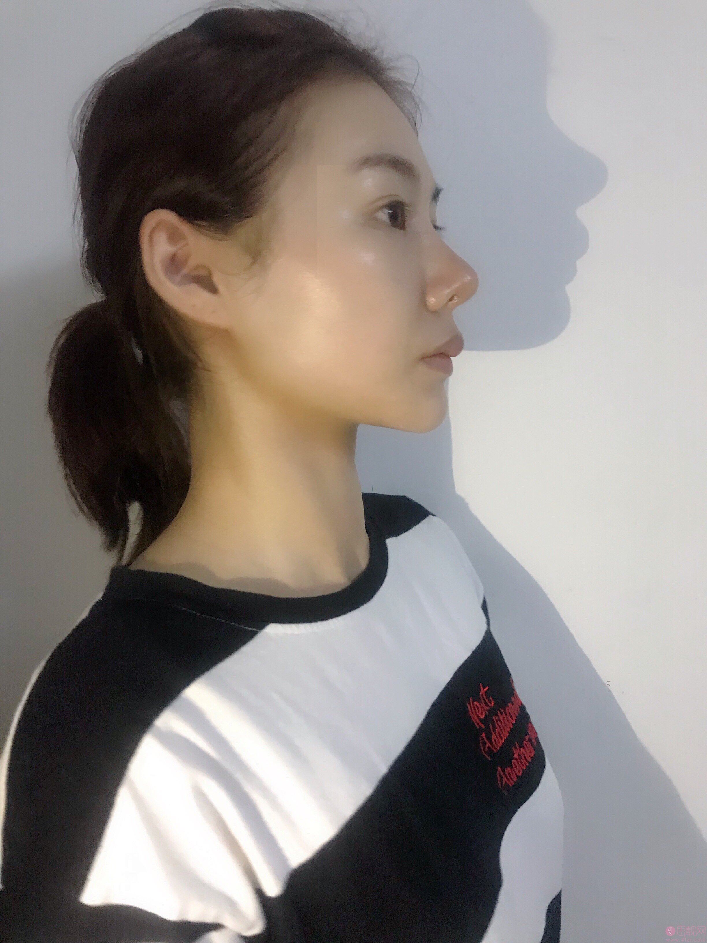 李晓东面部提升怎样？附案例及2020年价格表发布