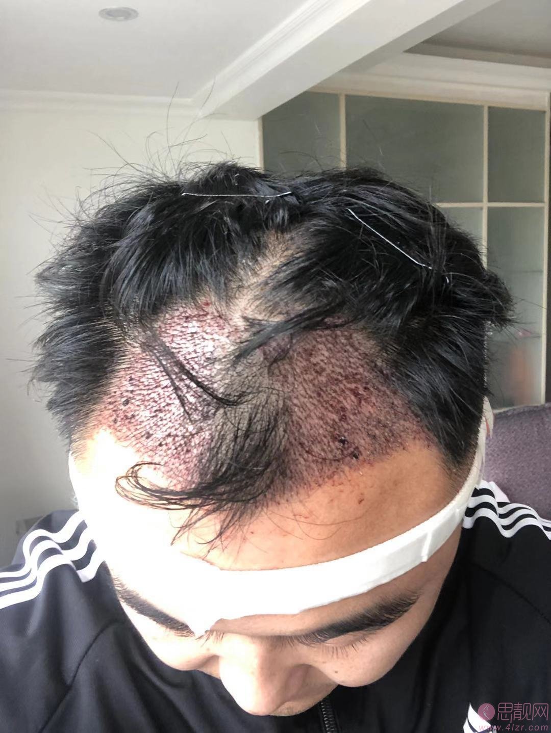 成都恒博植发植发怎么样？附案例及价格表明细一览
