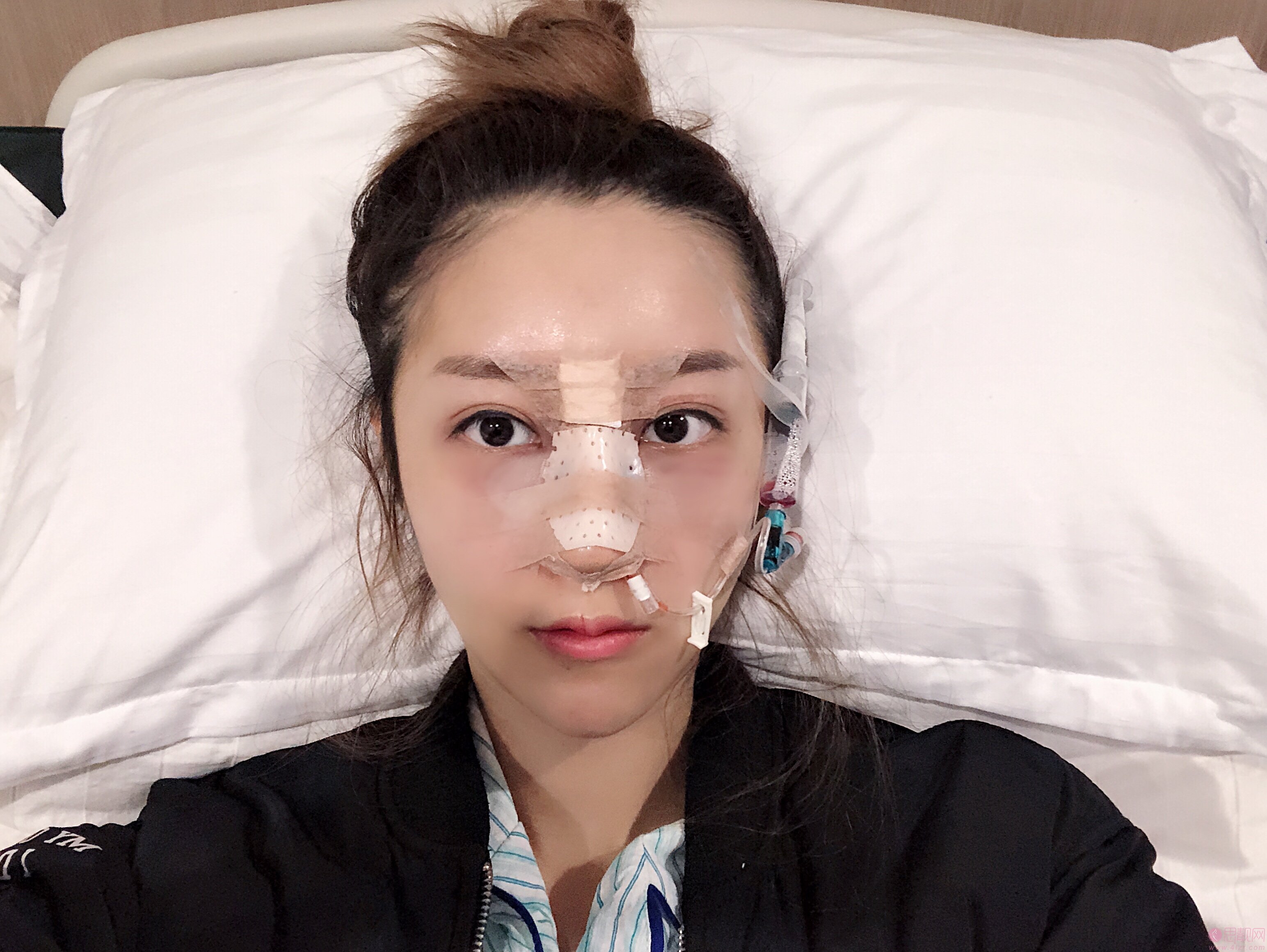 成都俏可丽整形贾德渊隆鼻多少钱？附价格表及案例展示
