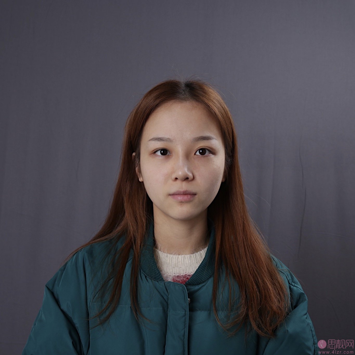 重庆联合丽格美容医院樊雯君医生做双眼皮好不好？附双眼皮真人案例及2020年价格表曝光