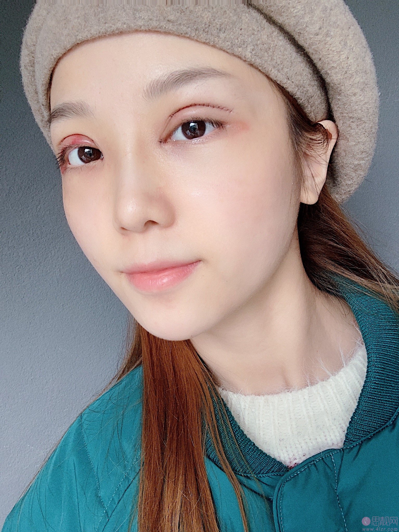 重庆联合丽格美容医院樊雯君医生做双眼皮好不好？附双眼皮真人案例及2020年价格表曝光