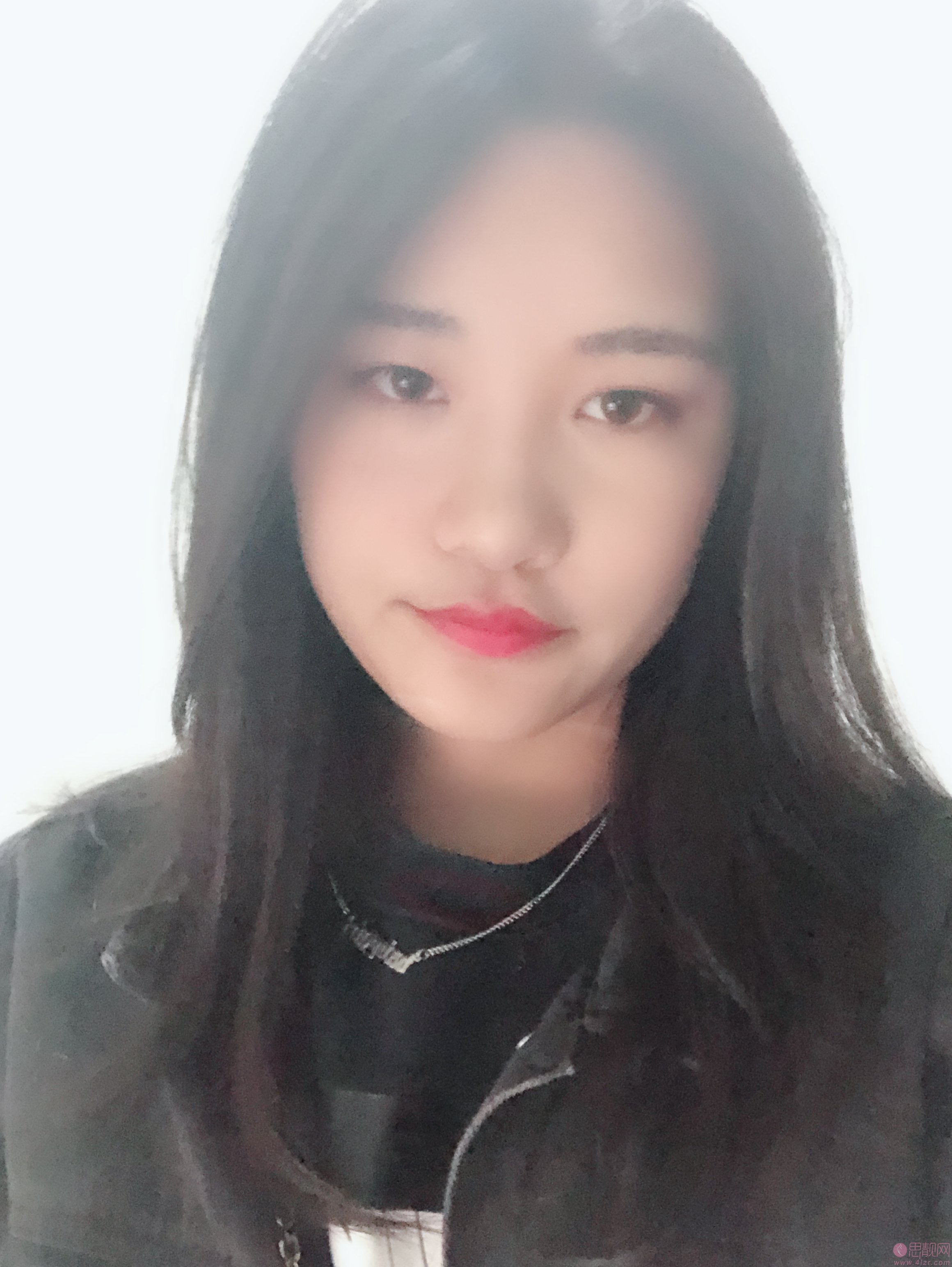 深圳春天阳光整形医院黄俊超做双眼皮如何？附双眼皮真人案例及价格表公布