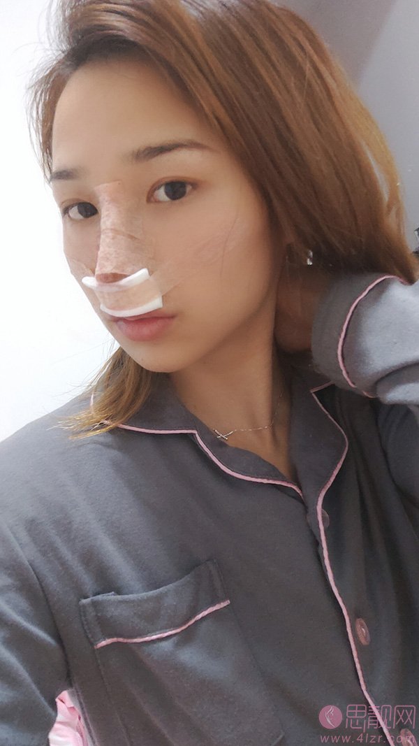 郑州美上美整形医院怎么样?附隆鼻真人案例反馈+2020年价格表公开