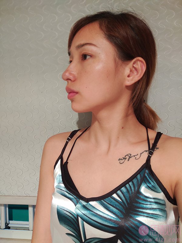 郑州美上美整形医院怎么样?附隆鼻真人案例反馈+2020年价格表公开