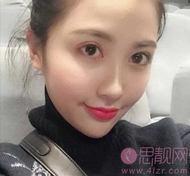 上海九院的光子嫩肤效果好吗?附案例分享+2020年价格表发布