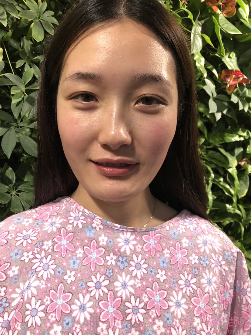 上海铂曼医疗美容2021年价格表发布+隆鼻案例分享