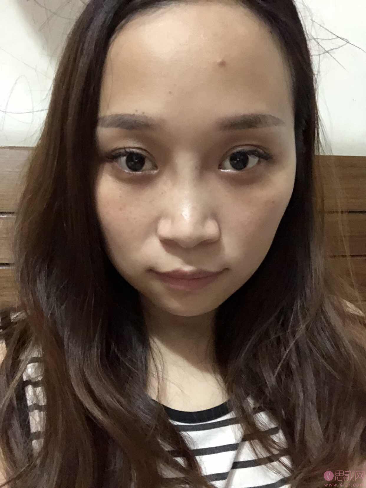 重庆美莱整形韦小勇隆鼻怎么样？附案例及2021年价格表一览
