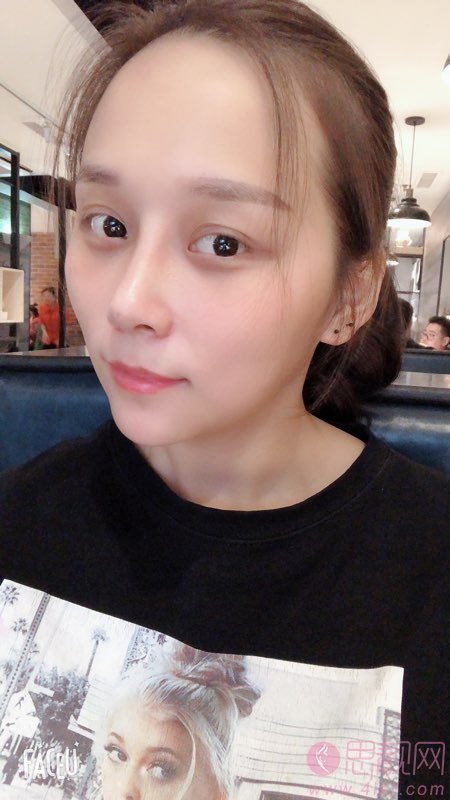 重庆美莱整形韦小勇隆鼻怎么样？附案例及2021年价格表一览