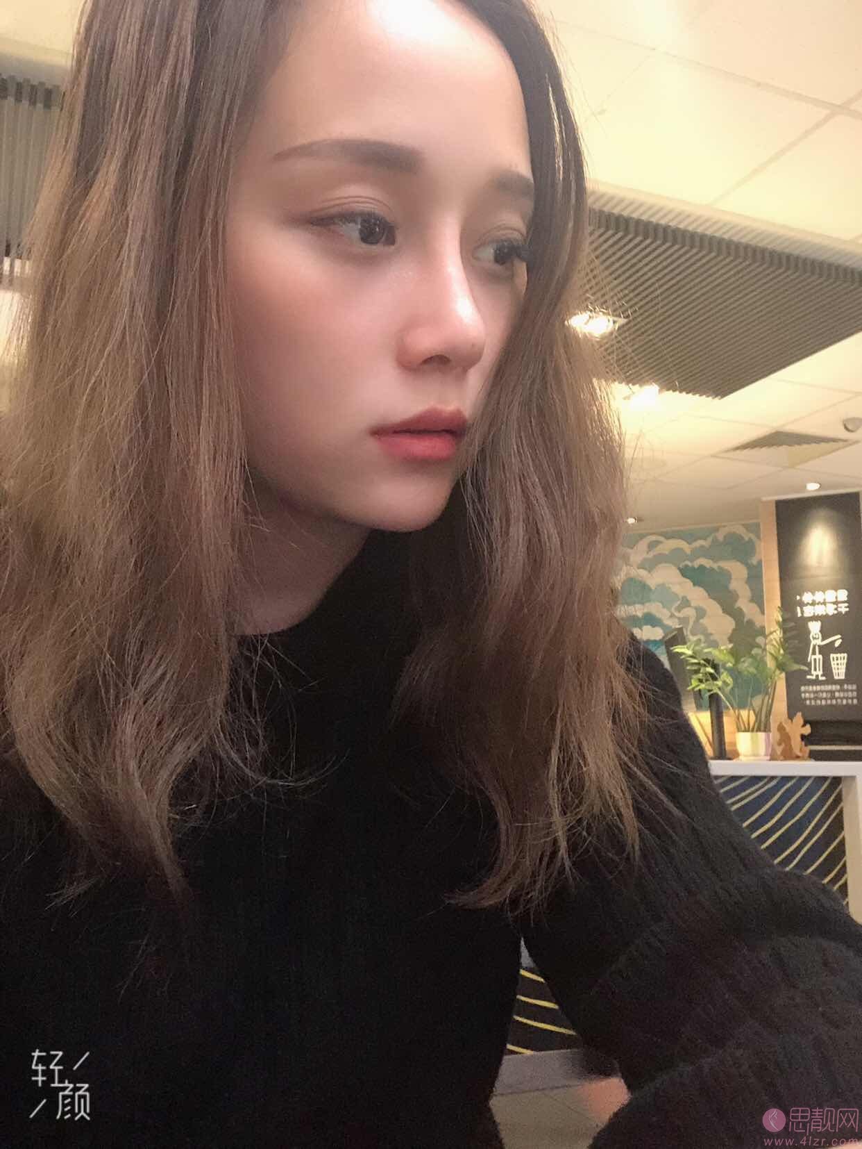 重庆美莱整形韦小勇隆鼻怎么样？附案例及2021年价格表一览