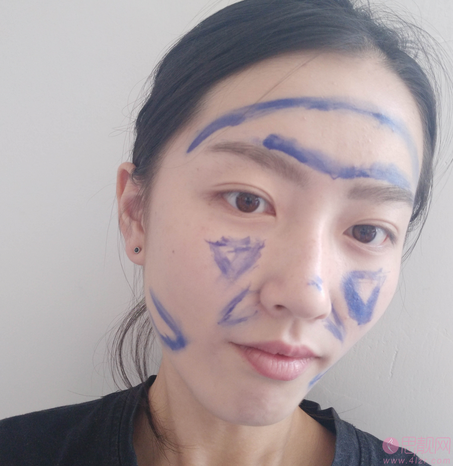 武汉仁爱时光王彬做自体脂肪全脸填充怎么样？附案例及2021年价格表发布