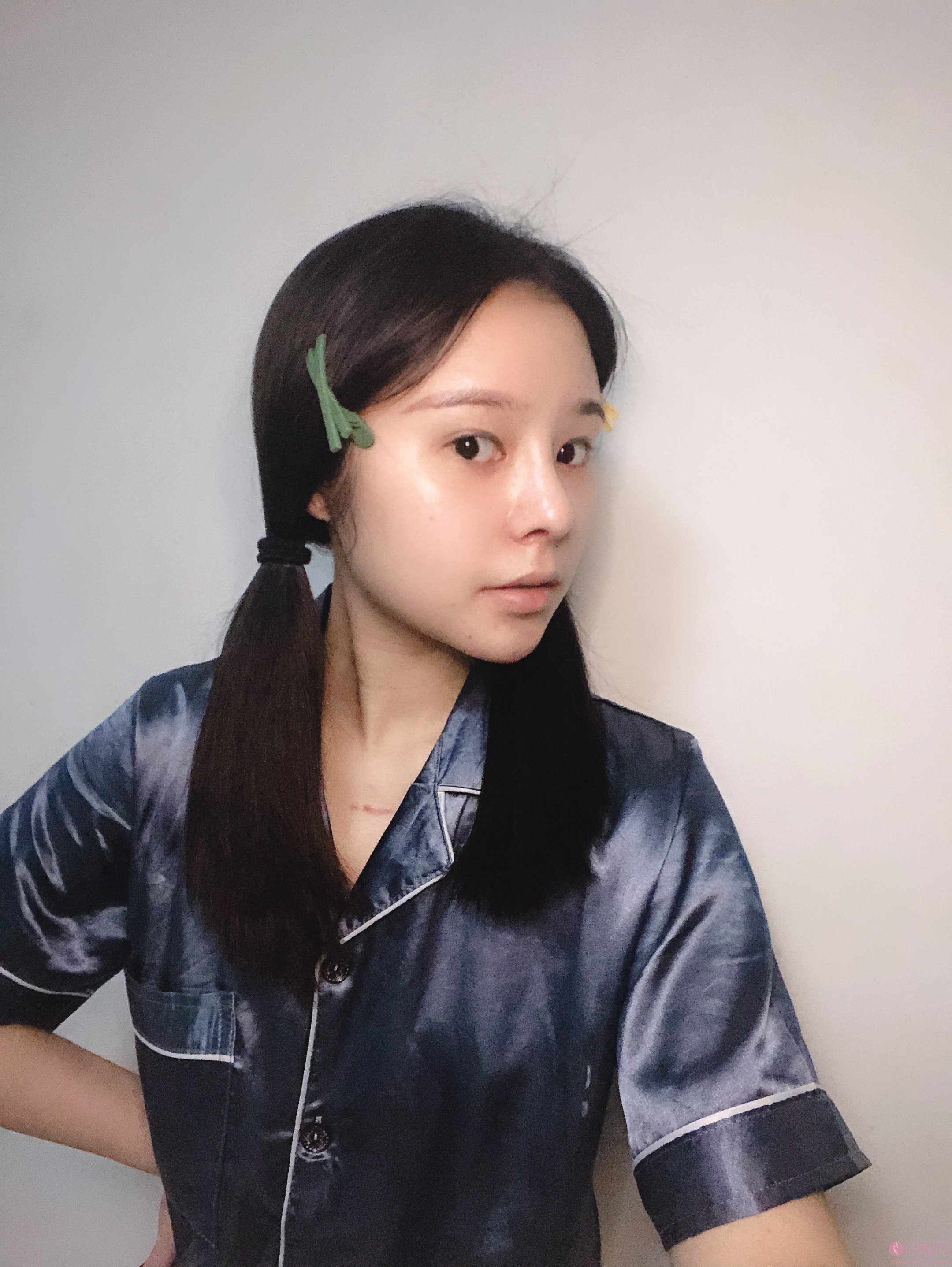 济南然之钥医疗美容苗春玲隆鼻案例分享+2021年价格表公布