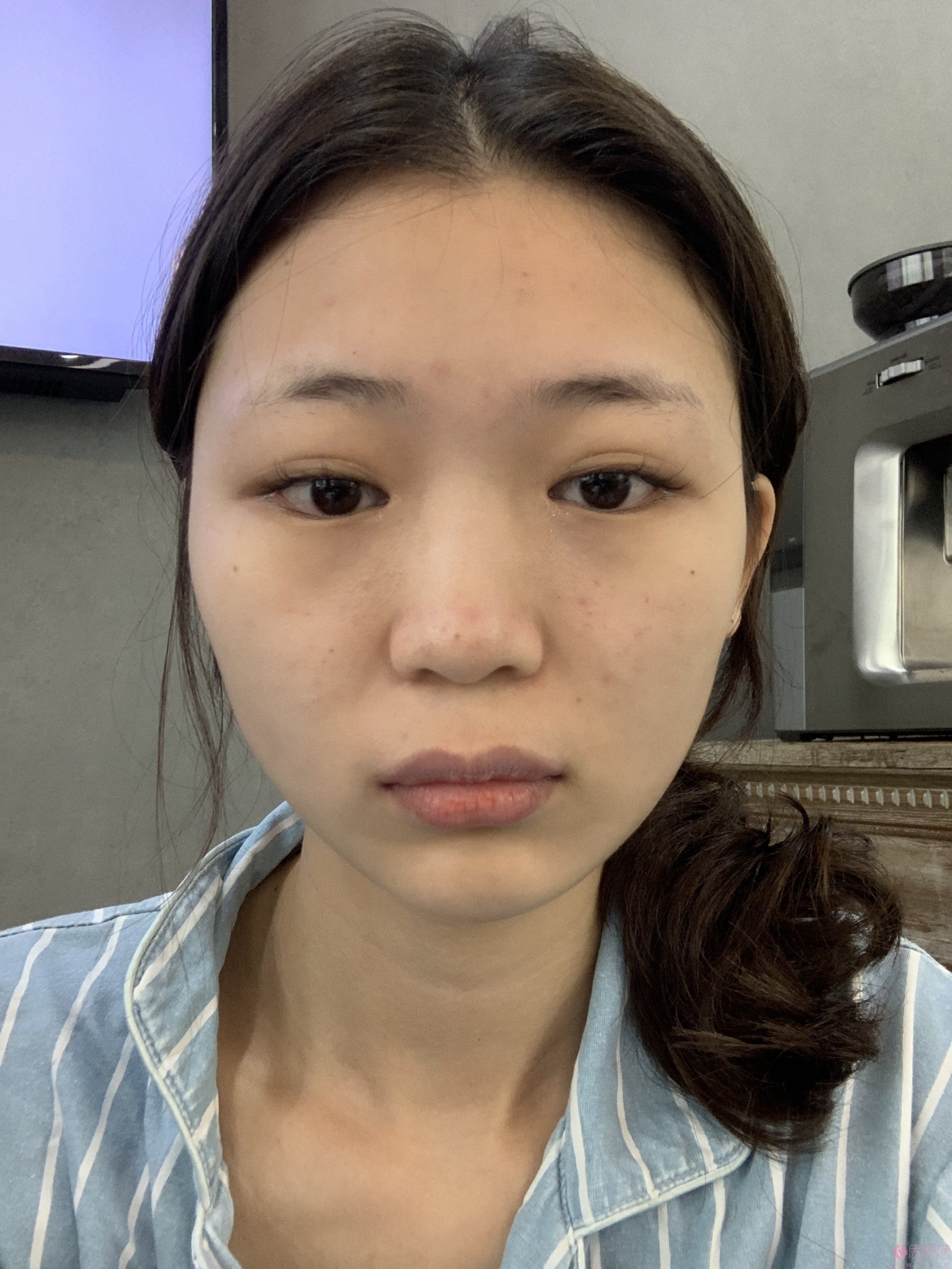 江苏省中医院黄金龙做鼻子怎么样？附隆鼻真人案例分享+2021年价格表发