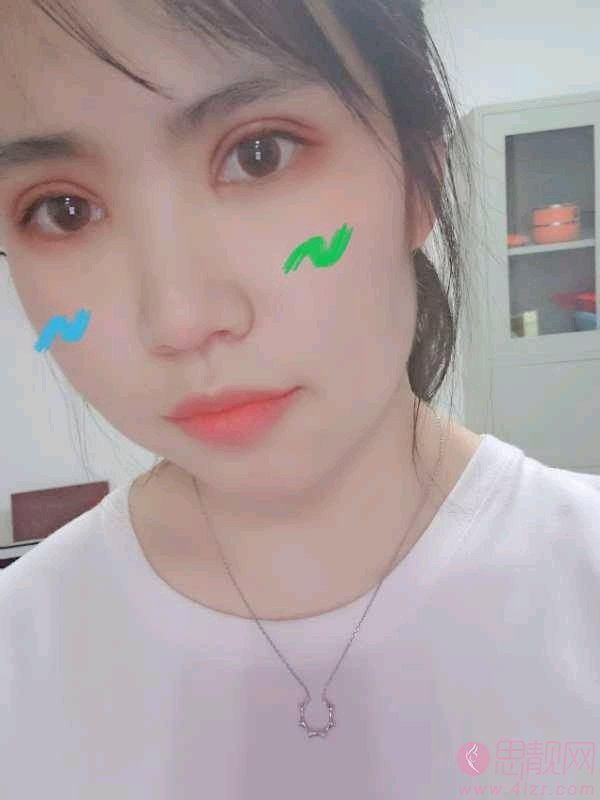 洛阳毛大夫普潇双眼皮到底怎么样？附双眼皮真人案例及2021年价格表一览
