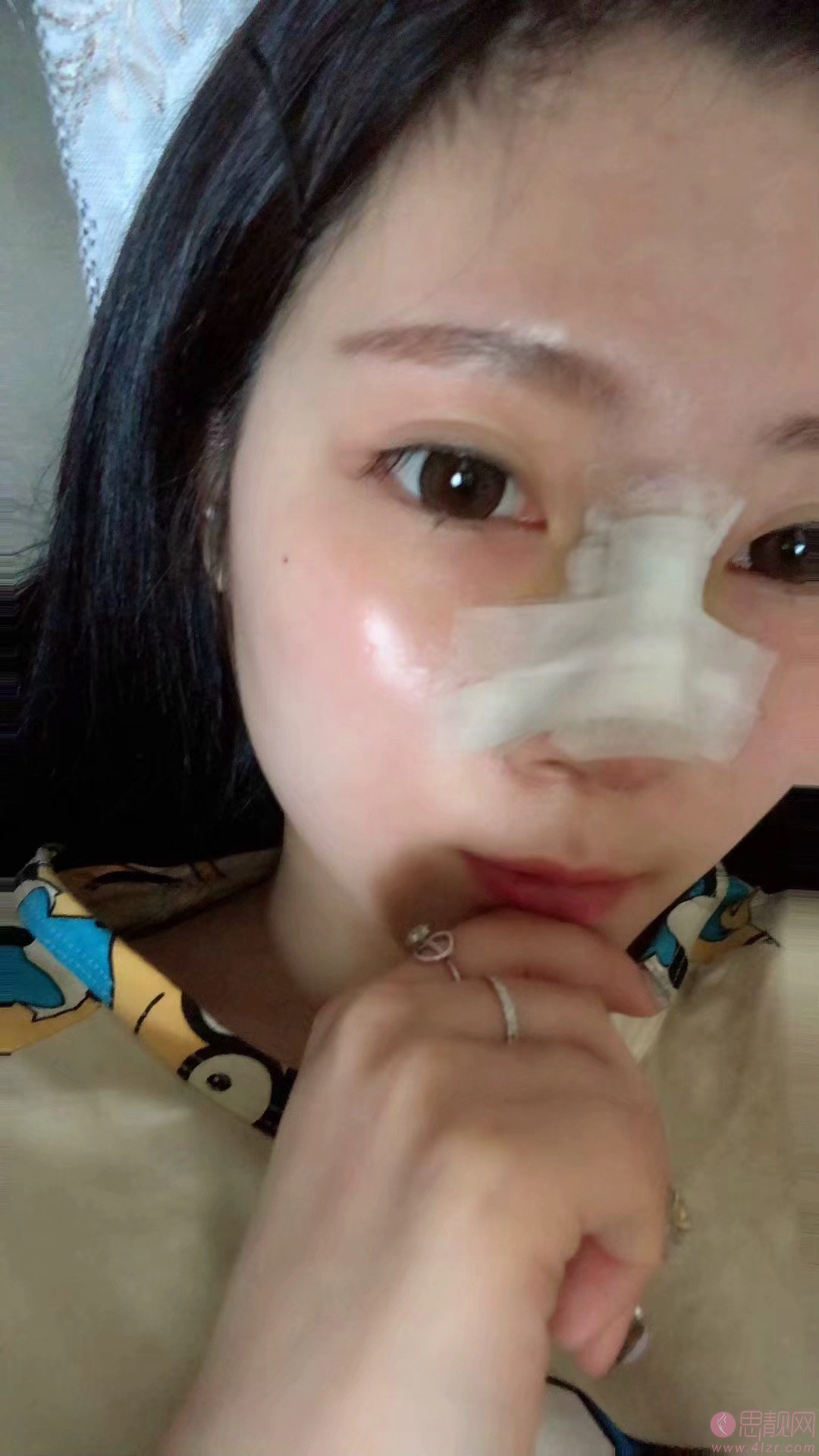 曾高医生做鼻子怎么样？附隆鼻案例分享+2021年价格表曝光