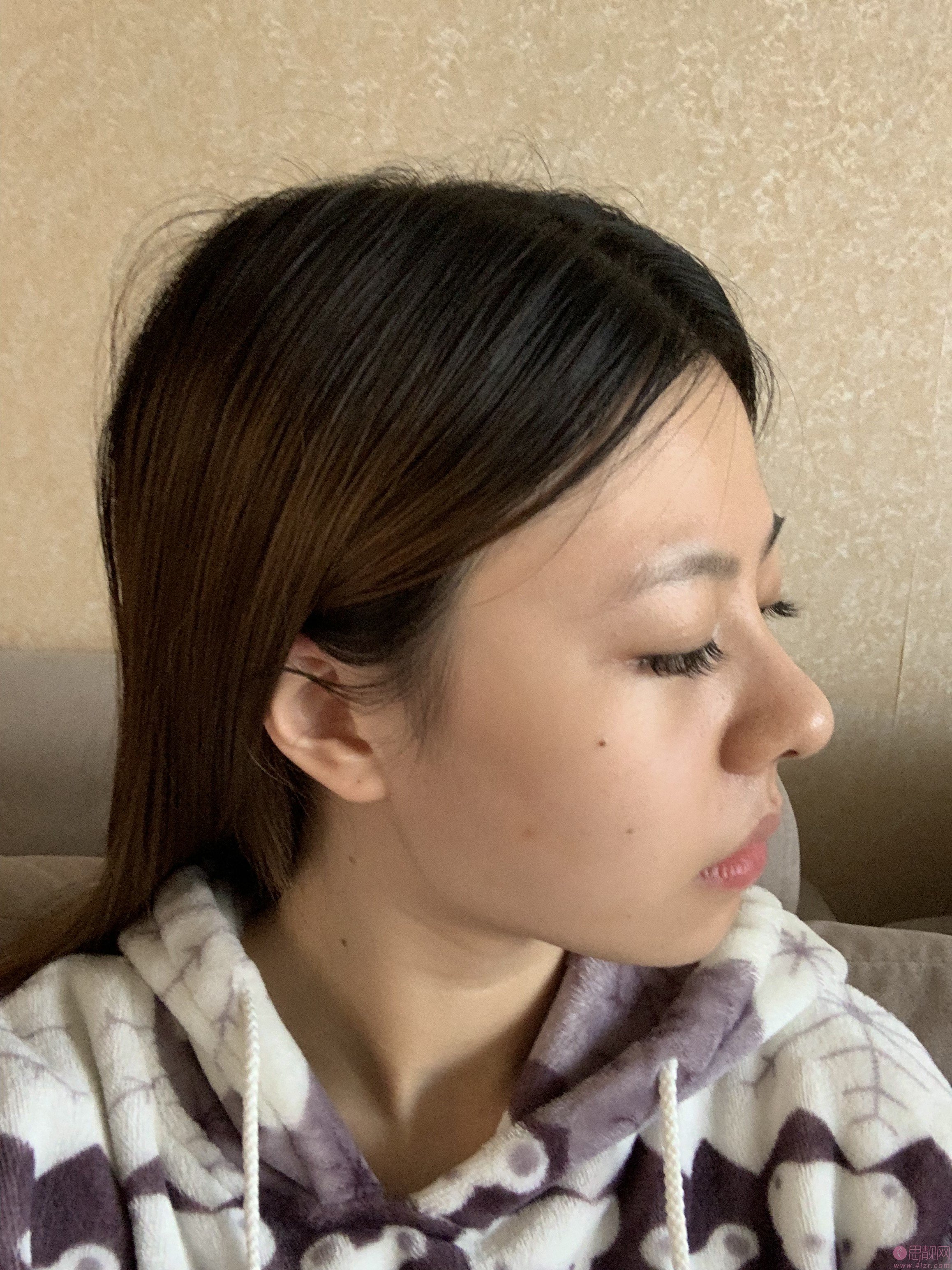 四川军大医美容整形医院隆鼻怎么样?附真人案例分享+2021年价格表曝光