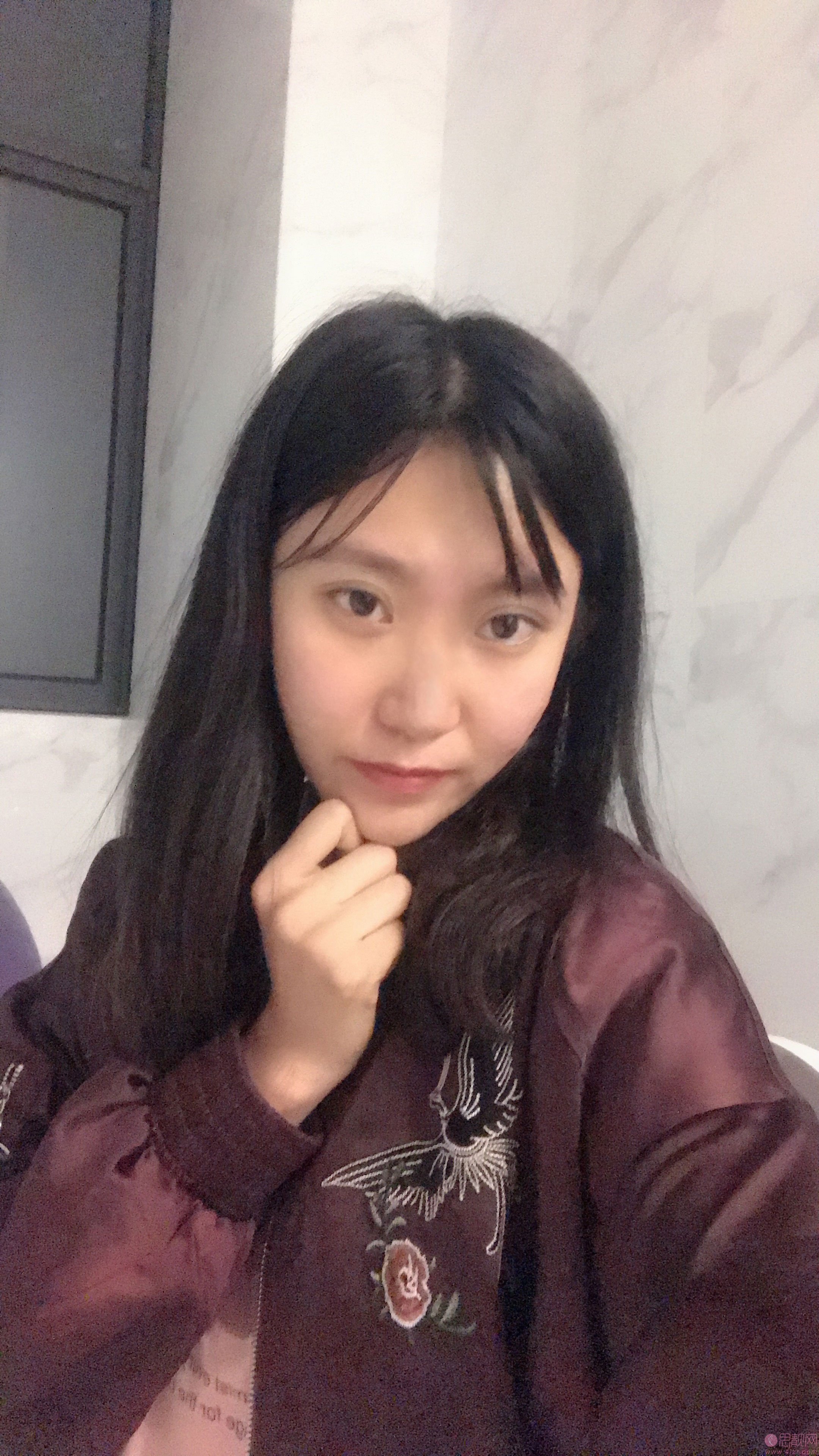 衡阳爱思特整容医院好不好？附医院介绍+隆鼻案例分享