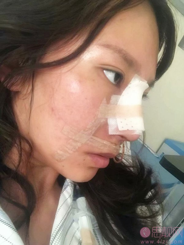 衡阳爱思特整容医院好不好？附医院介绍+隆鼻案例分享