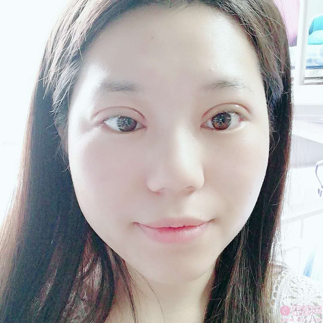 上海莫建民医生做双眼皮手术怎么样？附案例及2021年价格表公布