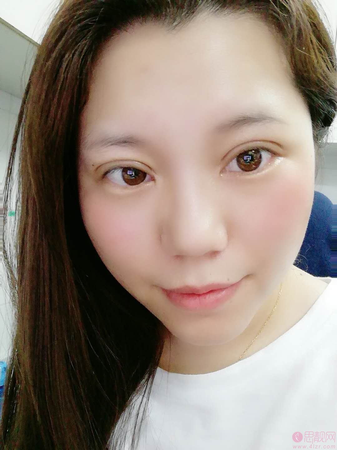 上海莫建民医生做双眼皮手术怎么样？附案例及2021年价格表公布