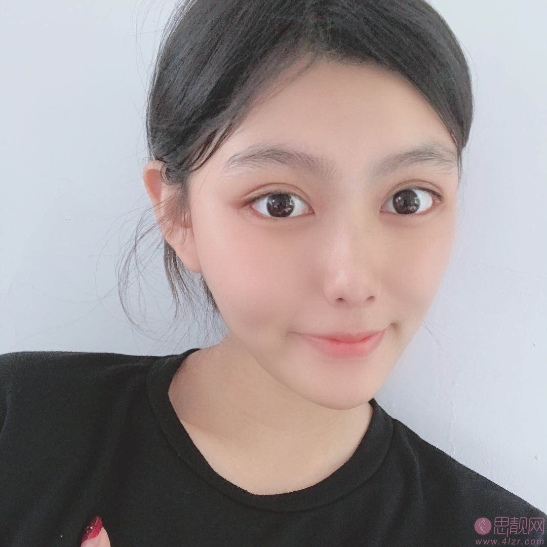 重庆当代整形做双眼皮好不好？附价格表及案例分享